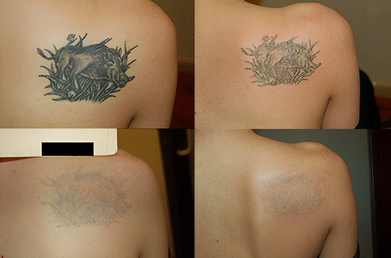 4 traitements (Gros tattoo)